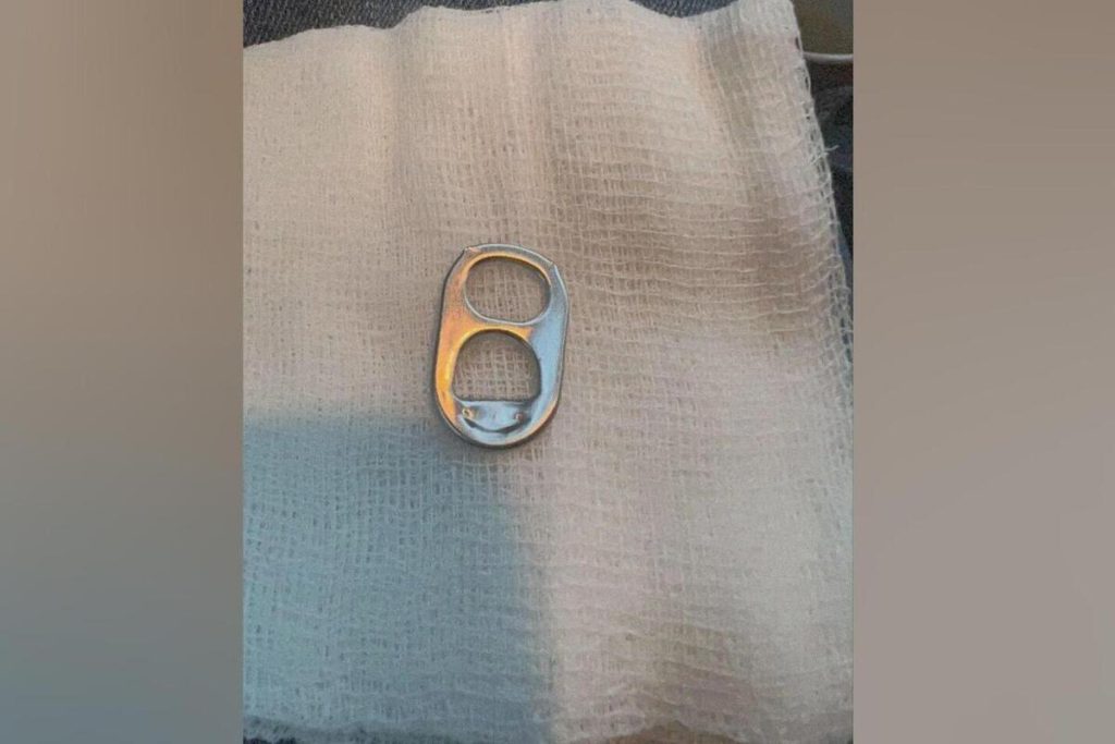 Bambino di un anno e mezzo salvato dopo aver inghiottito una chiave di lattina: l&#039;importanza della vigilanza e della prevenzione nella sicurezza dei più piccoli