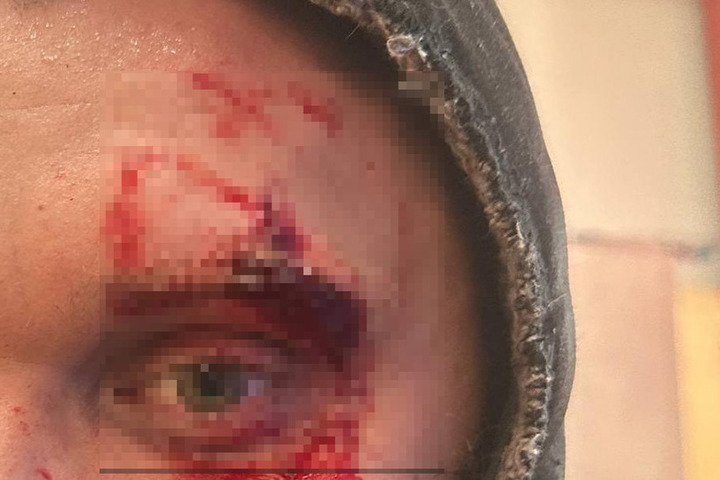 Direttore del Parco Forestale di Rjazan&#039; Ferito con un&#039;Ascia durante un Combattimento Medievale in Armatura