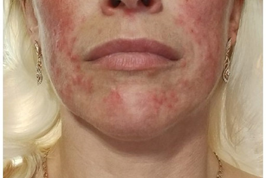 Опасность самолечения: случай стероидного дерматита у псковички напомнил о важности обращения к врачу