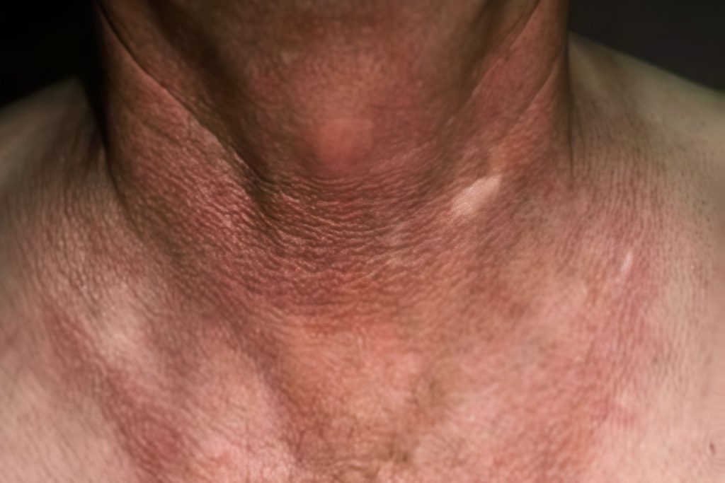 Хроническое заболевание кожи грозит нижегородцам-любителям парфюма