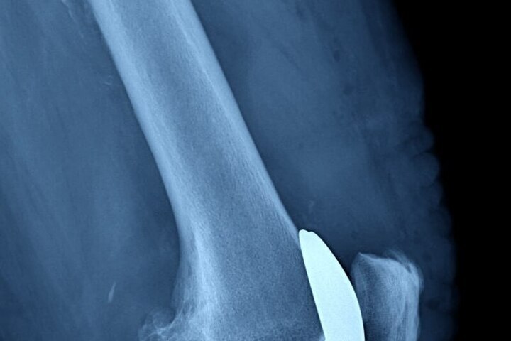 Операции по замене коленных суставов проводят и в Балахнинской ЦРБ