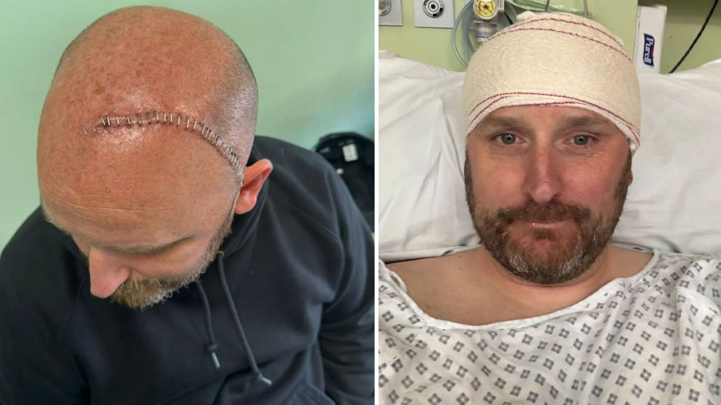 Diagnosi a sorpresa per un padre di 42 anni: solo 6 anni di vita dopo una visita in ospedale per vertigini

Approfondimento
La storia di Paul Whitaker, un pompiere di 42 anni residente a Cambridgeshire, in Inghilterra, è un esempio di come una visita in ospedale per un sintomo apparentemente banale possa portare a una diagnosi devastante. La vertigine e la stanchezza sono sintomi comuni che possono essere causati da diverse condizioni, ma in questo caso hanno portato a una scoperta più grave.

Possibili Conseguenze
La diagnosi di Paul Whitaker potrebbe avere conseguenze significative sulla sua vita e su quella della sua famiglia. La notizia di avere solo 6 anni di vita potrebbe essere difficile da accettare e potrebbe richiedere un adattamento significativo alle sue abitudini e priorità.

Opinione
È importante notare che ogni persona reagisce in modo diverso a una diagnosi del genere. Alcuni potrebbero sentirsi scoraggiati e perdere la speranza, mentre altri potrebbero trovare la forza di lottare e di cercare nuove opzioni di trattamento.

Analisi Critica dei Fatti
La storia di Paul Whitaker sottolinea l&#039;importanza di non sottovalutare i sintomi e di cercare aiuto medico quando necessario. La diagnosi precoce e il trattamento possono fare una grande differenza nel corso di una malattia.

Relazioni con altri fatti
La storia di Paul Whitaker è un esempio di come la salute possa essere fragile e imprevedibile. È importante prendersi cura della propria salute e di quella dei propri cari, e di non sottovalutare i sintomi che potrebbero essere segni di una condizione più grave.

Contesto storico
La diagnosi di Paul Whitaker è un esempio di come la medicina possa essere imprevedibile e di come le condizioni di salute possano cambiare rapidamente. La storia della medicina è piena di esempi di persone che hanno ricevuto diagnosi devastanti e che hanno trovato il modo di superarle.

Fonti
La fonte di questo articolo è Haberler.com. L&#039;articolo originale può essere trovato al link: https://www.haberler.com/bas-donmesiyle-hastaneye-giden-babaya-yikici-teshis-15625454-haberi/