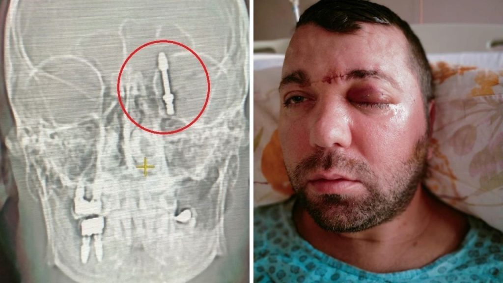Beynine saplanan implant hayatını kabusa çevirdi! Diş hekimine verilen cezaya isyan etti