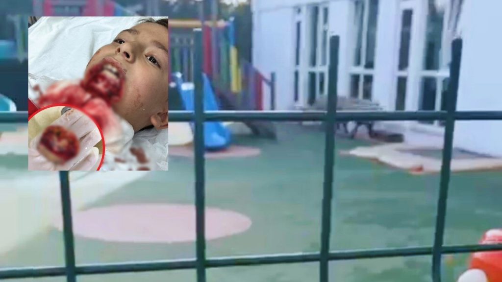 Çanakkale&#039;de 7 yaşındaki çocuğun çenesi koptu! Ailesi hukuk mücadelesi başlattı