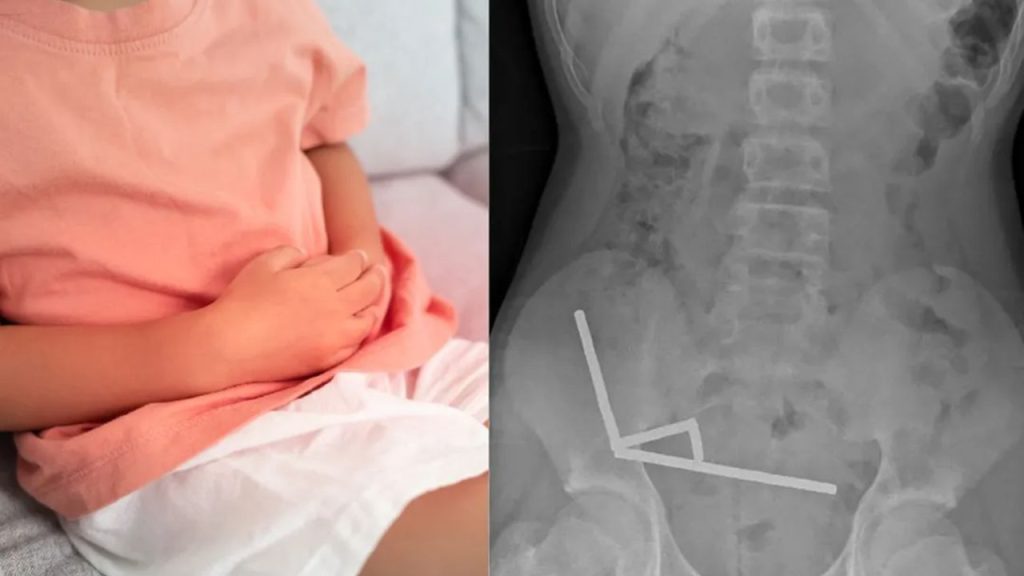 Oyun sanmıştı, kabusa döndü! 13 yaşındaki çocuk 200 mıknatıs yuttu