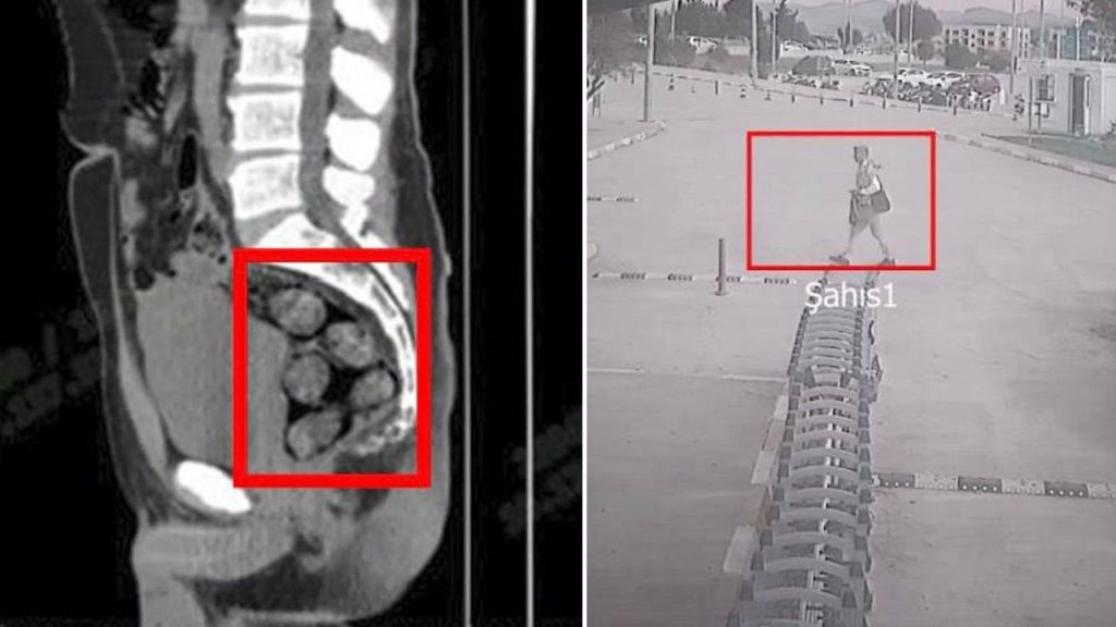 Tomografide şok eden görüntü! Midesinden çıkanların ardından hapsi boyladı
