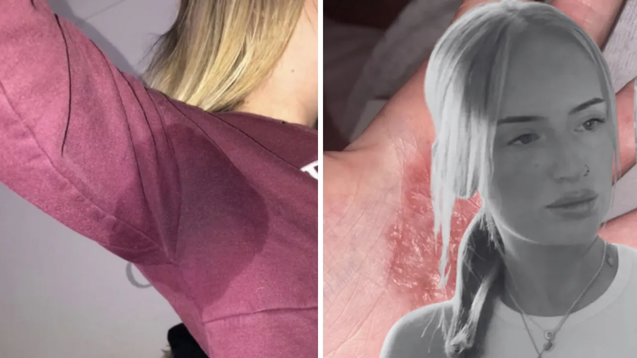 Darcie Hamilton, 22 anni, la lotta contro l'iperidrosi che ha portato all'abbandono della scuola