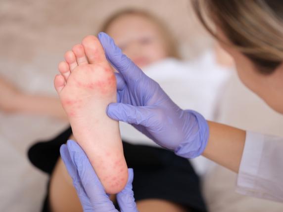 Come riconoscere la malattia mani, bocca e piedi e distinguerla dalla varicella