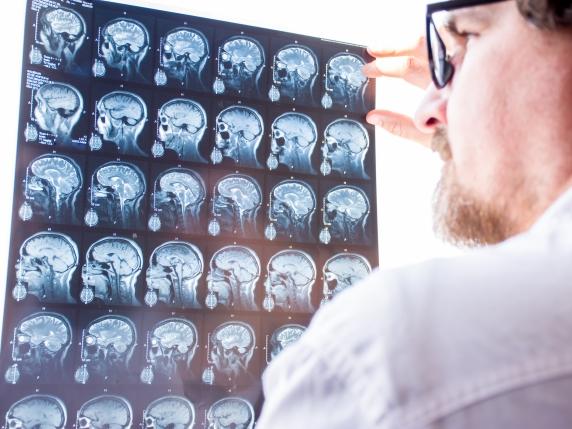 Proteina cerebrale scoperta come possibile indicatore della gravità della sclerosi multipla