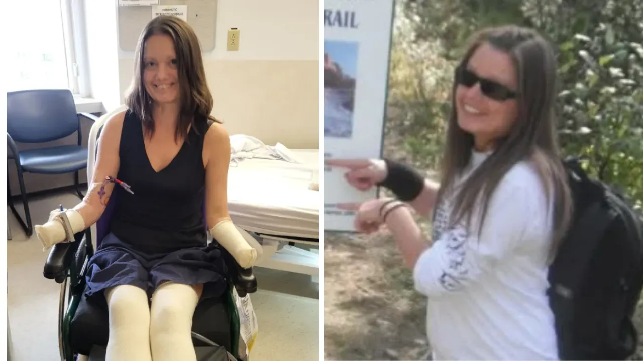 Shock tossico da streptococco di gruppo A porta a amputazioni di mani e piedi in Alberta