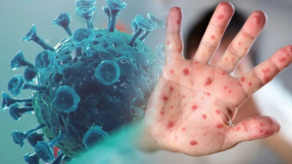 Nuova Variante del Vaiolo delle Scimmie: Una Minaccia Globale in Rapida Diffusione