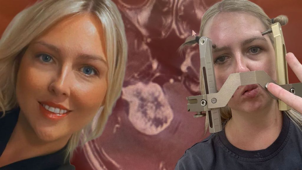 Una diagnosi tardiva: la storia di Tamara e le conseguenze di un tumore cerebrale ignorato per anni