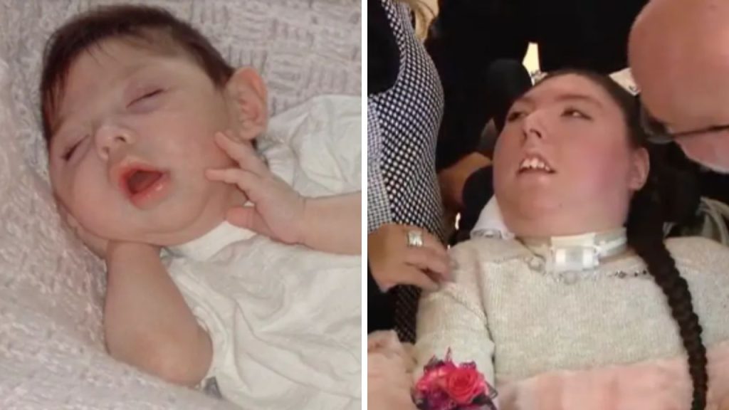 Un giovane contro tutte le previsioni: la storia di Alex Simpson, il ragazzo senza cervello che ha compiuto 20 anni