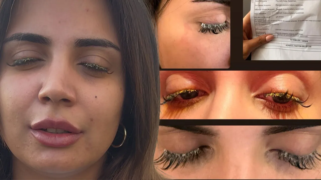 Incidente in centro estetico di Istanbul: adesivo per ciglia finito nell'occhio provoca perdita parziale della vista e denuncia di molestie