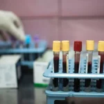 Cancro della vescica: riconoscere i segni del pericolo silenzioso